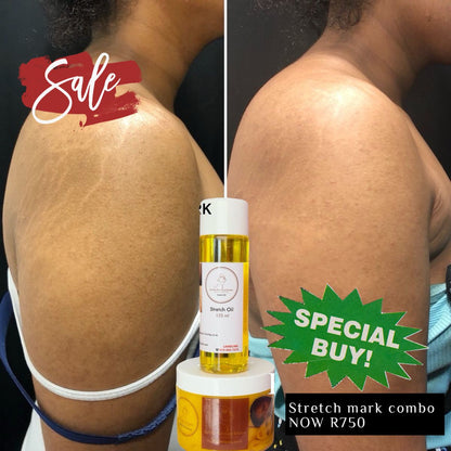 Stretch Mark Remover Combo